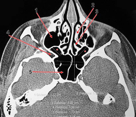 Maxillary Sinuses Anatomy