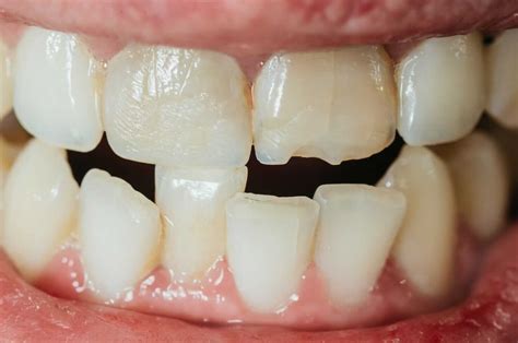 Cracked Tooth Syndrome