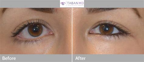 Almond Eye Surgery Before and After Gallery | Taban MD