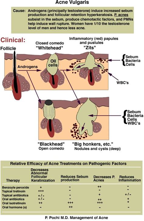 Clinical Look at Acne Vulgaris ! | Acne vulgaris, Acne cure, Skin facts