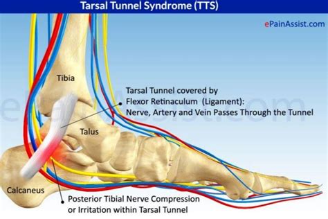 Tarsal Tunnel Syndrome | Podiatrist in Torrance, Los Angeles & San ...