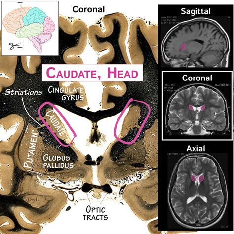 Neuroanatomy Glossary: Caudate nucleus, head | Draw It to Know It