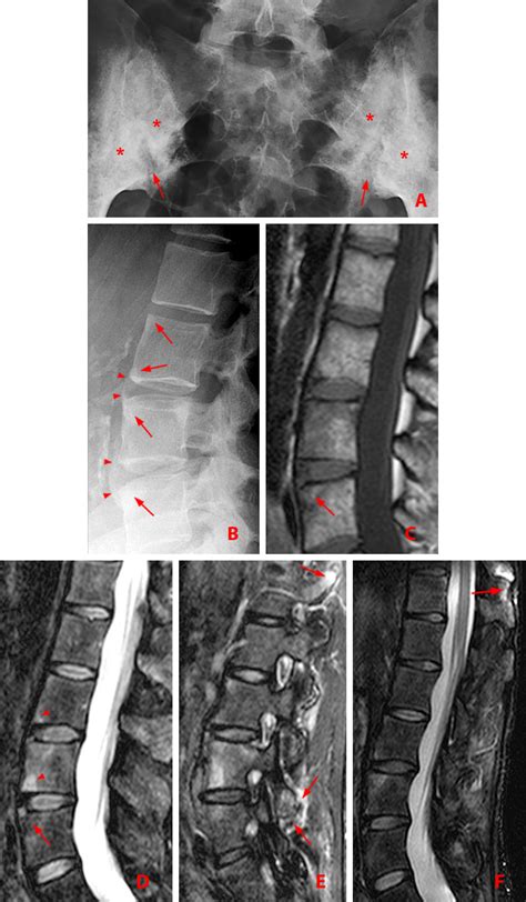 Ankylosing Spondylitis MRI SI Joint