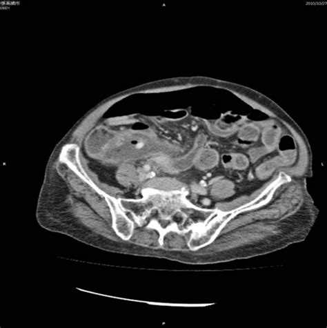 Figure 1 from Drainage of Periappendiceal Abscess and Removal of Free ...