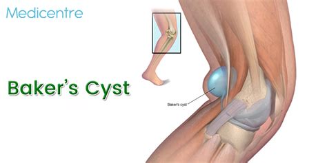 Baker’s Cyst - Causes, Symptoms & Treatments