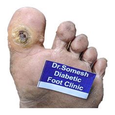 Diabetic Gangrene stages-Great Toe Base - Podiatry Doctor