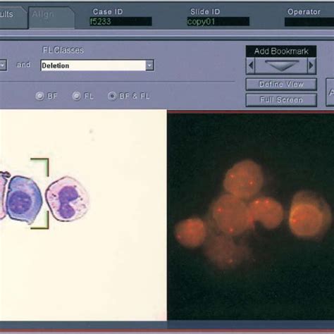 Combined morphologic and I-FISH analysis of a plasma cell (PC). The... | Download Scientific Diagram