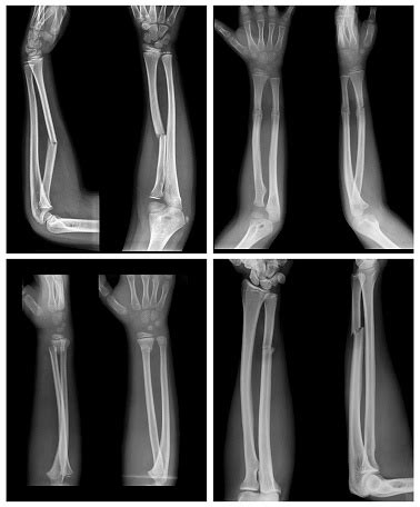 Collection of X-ray image of Forearm bone fracture in child's (Radius bone, Ulna bone) Stock Photos