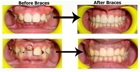 Best Dentist in South Delhi for Braces | Dental Treatment Braces ...