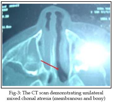 Unilateral choanal atresia in adults