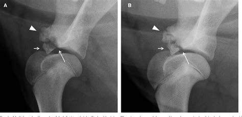 Figure 4 from Imaging diagnosis-bilateral abnormal ossification of the supraglenoid tubercle and ...