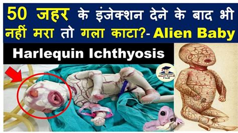 Harlequin Ichthyosis: A severe genetic disorder that affects the skin | Alien Baby #upsc #ias # ...