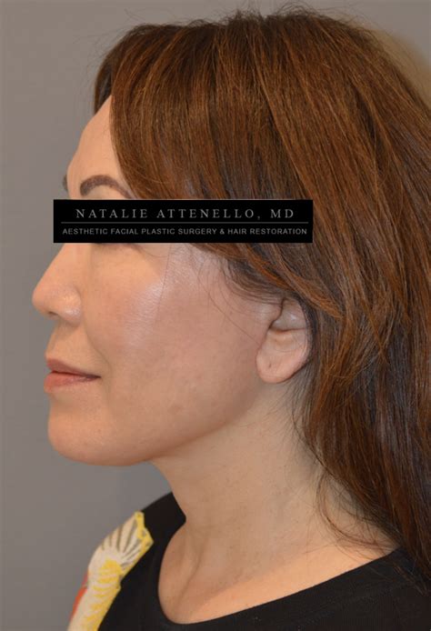 Beverly Hills Facelift Before and After Photos - Los Angeles Plastic ...