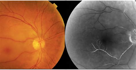 Manejo de la Isquemia aguda de la retina – SERV – Sociedad Española de Retina y Vítreo