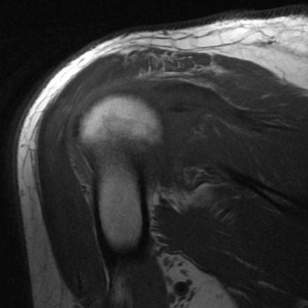 Rotator cuff tear | Radiology Reference Article | Radiopaedia.org