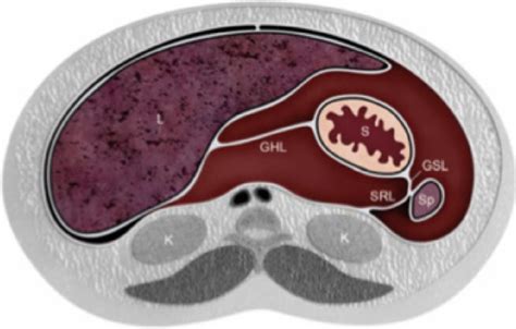 Graphic illustration of some perisplenic ligaments, in addition to the ...