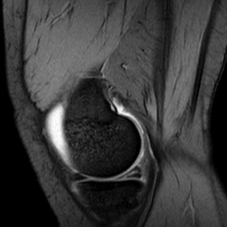 Horizontal Meniscal Tear Mri