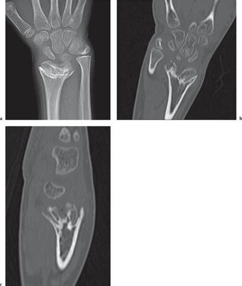 Epiphysis: Supernumerary Epiphyseal Ossification Centers | Radiology Key