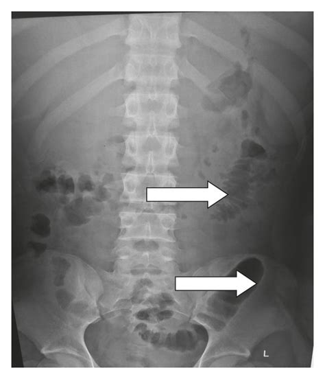 Sentinel loop sign and colon cut-off sign in a similar plain abdominal ...