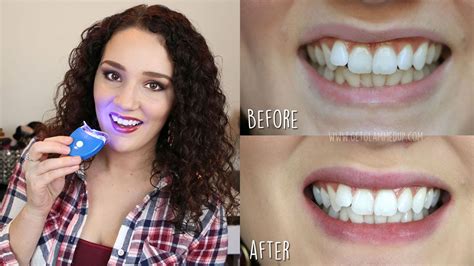 Teeth Whitening Tips - What You Need To Know - AquaRiva