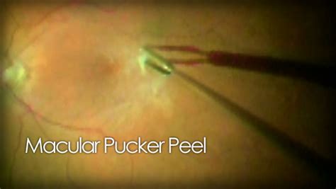 Macular pucker peel surgery video