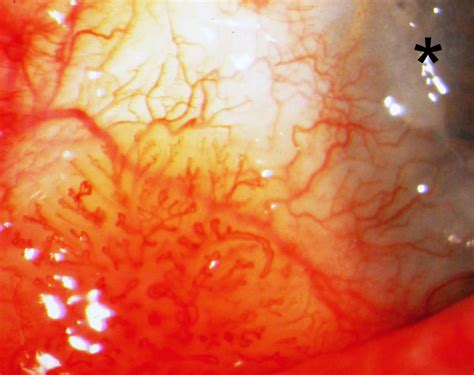 Conjunctival squamous intraepithelial neoplasia - Clinical Laboratory int.