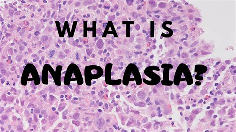 What is Anaplasia? - Pathology mini tutorial - YouTube