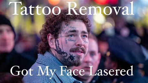 I got my face lasered…tattoo removal. - YouTube