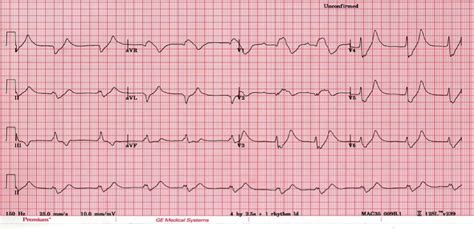 Hyperkalaemia Clinical Case • LITFL • Clinical case