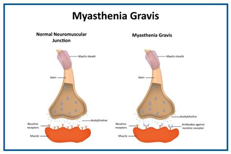 Myasthenia Gravis: Symptoms, Causes, Treatment & Risk Factors