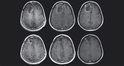 Brain Mri Tumor