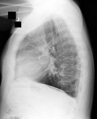 Asbestosis | Lung Disease, Fibrosis & Scarring | Britannica