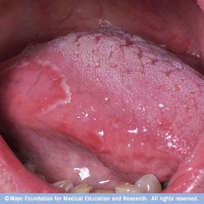 Geographic tongue Disease Reference Guide - Drugs.com