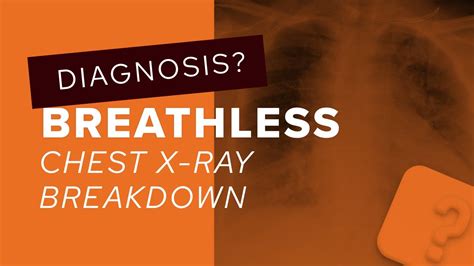 Chest X-Ray breakdown: assessing mediastinal contour on an AP film ...