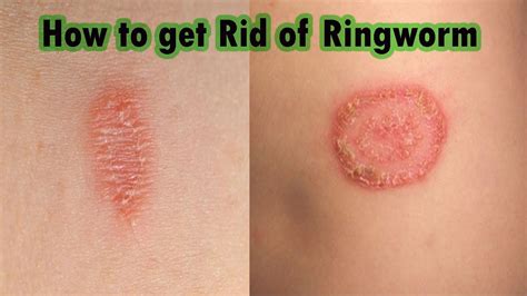 Ringworm Treatment At Home : 7 Steps on How to Cure Ringworm Fast! - YouTube