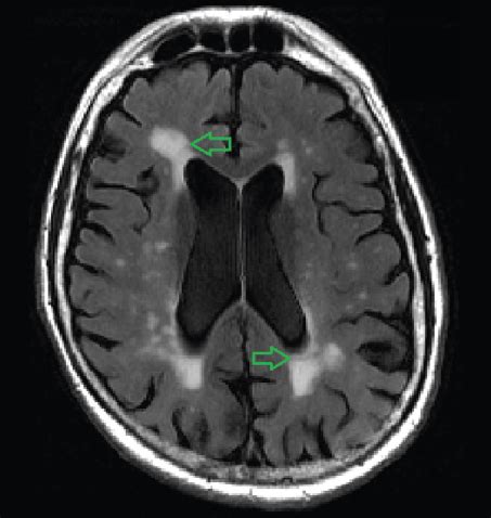 What are White Matter Lesions, and When Are They a Problem?