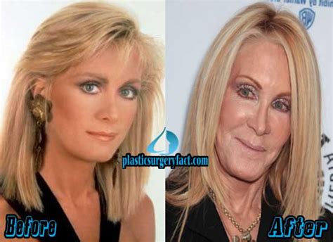 Joan Van Ark Plastic Surgery Before and After Pictures