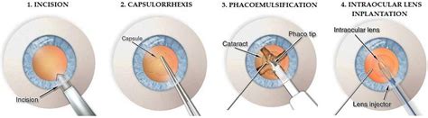 Recovery after cataract surgery - Porela‐Tiihonen - 2016 - Acta Ophthalmologica - Wiley Online ...