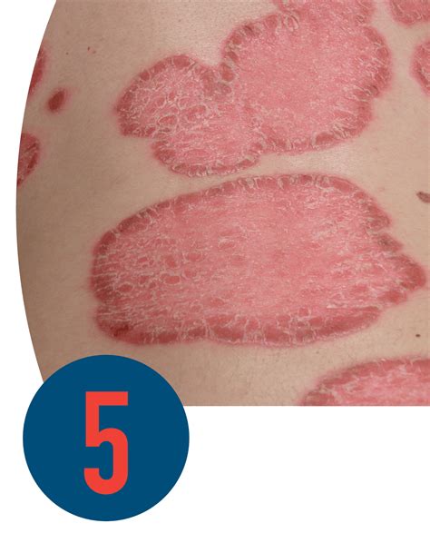 Top 104+ Pictures Pictures Of Different Types Of Psoriasis Sharp