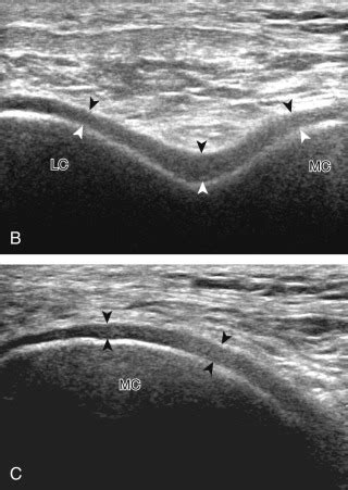 Knee Ultrasound | Radiology Key