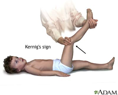 Kernig's sign of meningitis: MedlinePlus Medical Encyclopedia Image