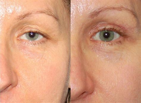 Eyelid Surgery - Upper & Lower, Blepharoplasty Surgery, Recovery