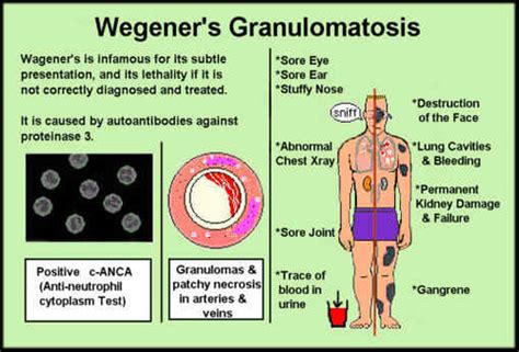 2-18 Vasculitis Flashcards | Quizlet