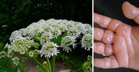 How To Avoid Severe Burns And Blisters From The Giant Hogweed Plant