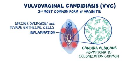 Vaginitis Antifungal | informacionpublica.svet.gob.gt