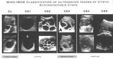 Hydatid Cyst