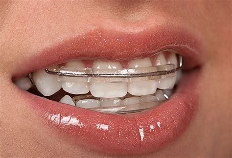 The Pros and Cons of Fixed Retainers and Removable Retainers