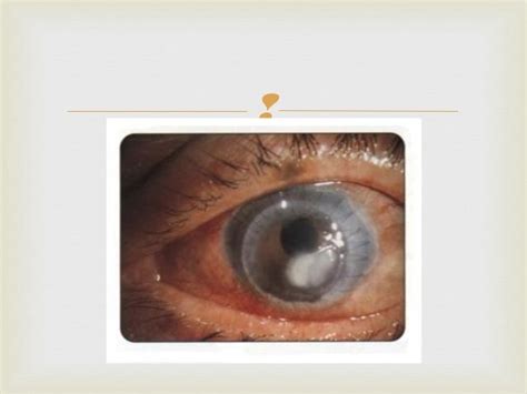 Diseases of the Cornea