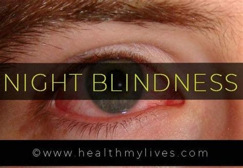 Prevention Of Night Blindness - Home Interior Design