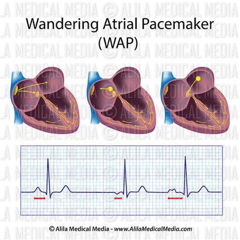 Alila Medical Media | Wandering atrial pacemaker (WAP) | Medical illustration